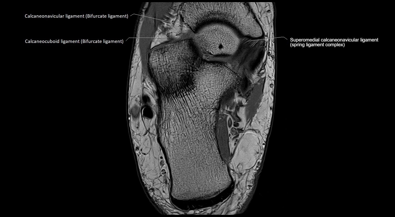 MRI ankle ligaments anatomy axial 3T image 18.webp